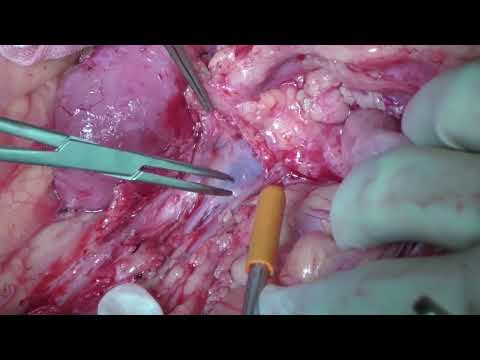 VID01: Pancreas 1