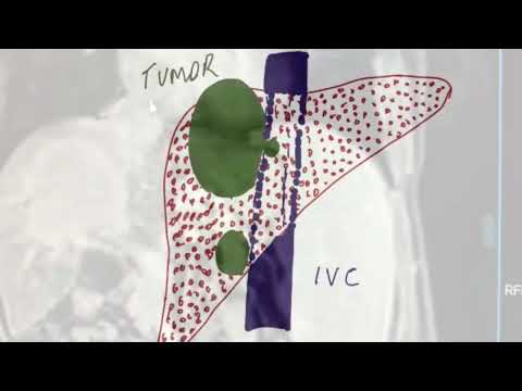 VID02: Transplant
