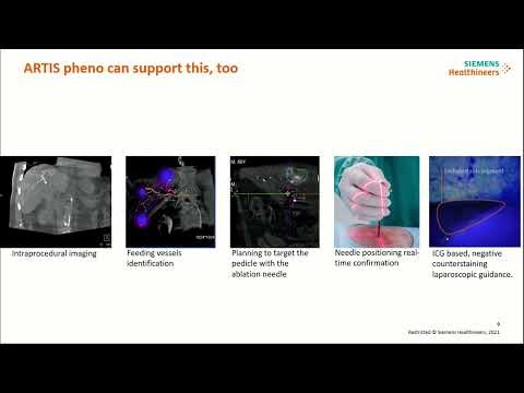 IS05: Round Table for Hybrid Operating Rooms&rsquo; Potential in HBP Therapies, and Quality in Ablation