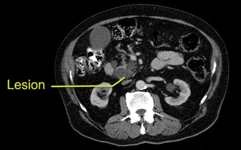intro-Tumor